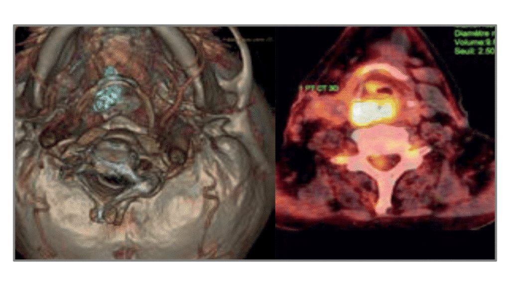 Miniature du DU Carcinologie cervico-faciale de Gustave Roussy et de l'université Paris-Saclay.