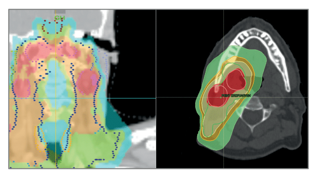 Illustration du DU radiothérapie des cancers ORL de Gustave Roussy